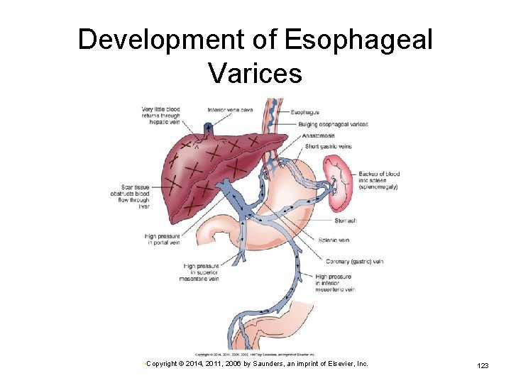 Development of Esophageal Varices • Copyright © 2014, 2011, 2006 by Saunders, an imprint
