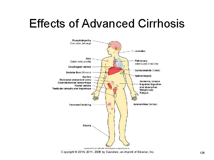 Effects of Advanced Cirrhosis • Copyright © 2014, 2011, 2006 by Saunders, an imprint
