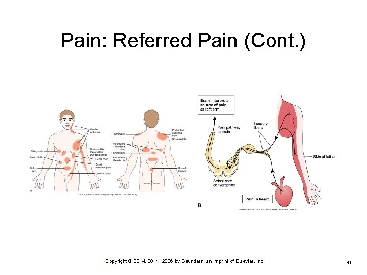 Pain: Referred Pain (Cont. ) • Copyright © 2014, 2011, 2006 by Saunders, an