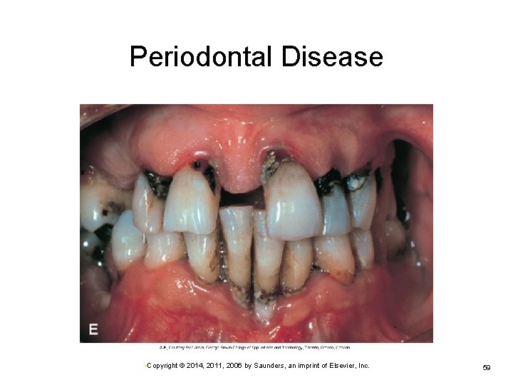 Periodontal Disease • Copyright © 2014, 2011, 2006 by Saunders, an imprint of Elsevier,