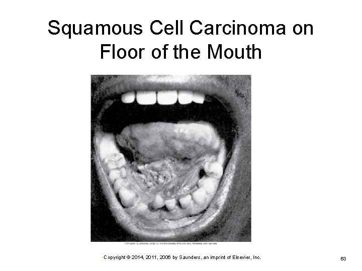 Squamous Cell Carcinoma on Floor of the Mouth • Copyright © 2014, 2011, 2006