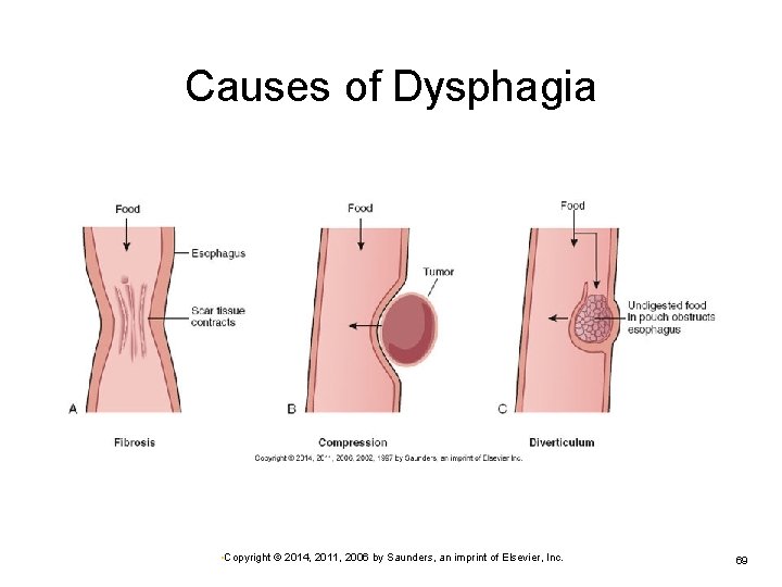 Causes of Dysphagia • Copyright © 2014, 2011, 2006 by Saunders, an imprint of