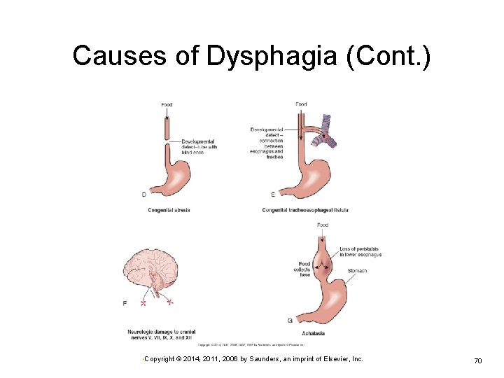 Causes of Dysphagia (Cont. ) • Copyright © 2014, 2011, 2006 by Saunders, an
