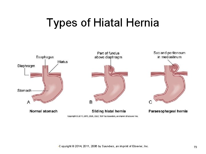 Types of Hiatal Hernia • Copyright © 2014, 2011, 2006 by Saunders, an imprint
