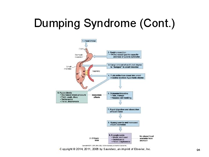 Dumping Syndrome (Cont. ) • Copyright © 2014, 2011, 2006 by Saunders, an imprint
