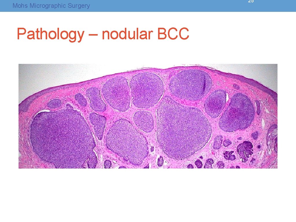 Mohs Micrographic Surgery Pathology – nodular BCC 25 Mohs Micrographic Surgery Pathology – nodular BCC 25