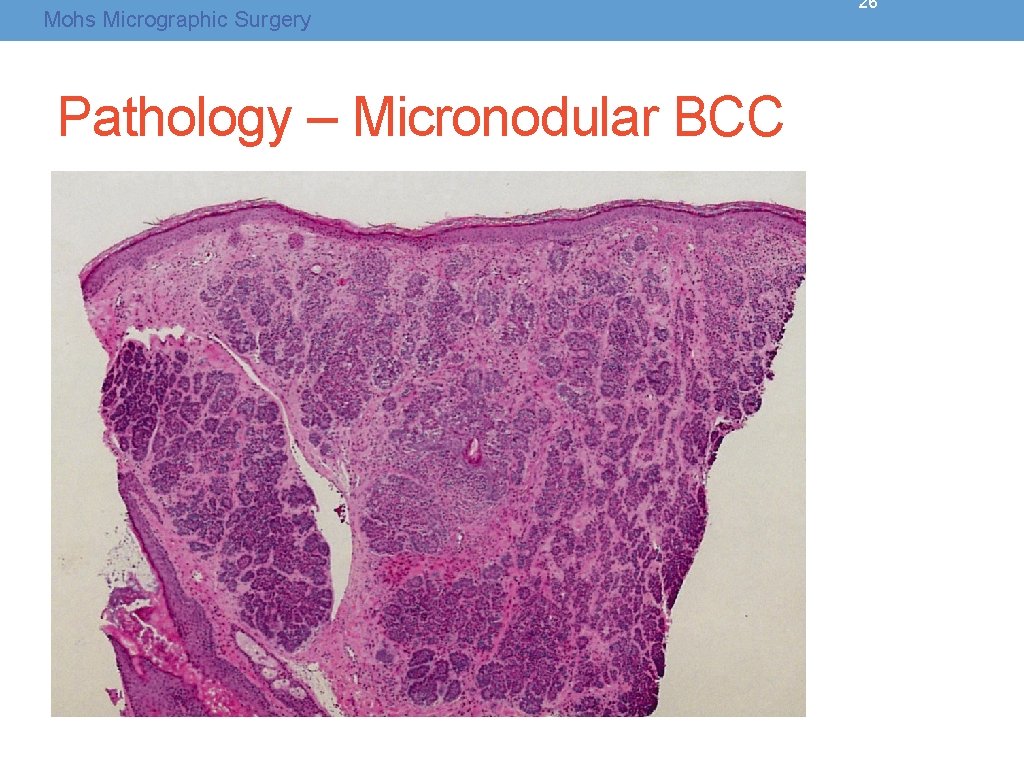 Mohs Micrographic Surgery Pathology – Micronodular BCC 26 Mohs Micrographic Surgery Pathology – Micronodular BCC 26