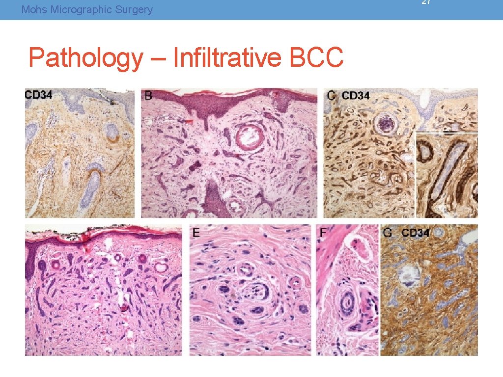 Mohs Micrographic Surgery Pathology – Infiltrative BCC 27 Mohs Micrographic Surgery Pathology – Infiltrative BCC 27