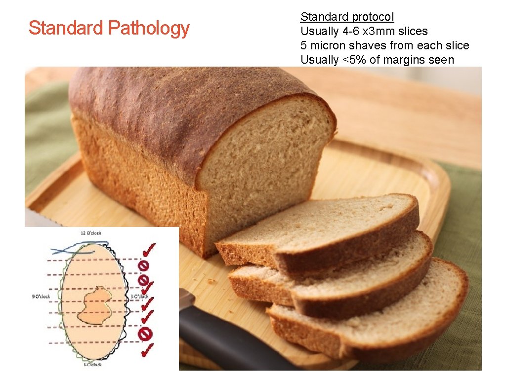 Of 75 Standard Pathology Standard protocol Usually 4 -6 x 3 mm slices 5 Of 75 Standard Pathology Standard protocol Usually 4 -6 x 3 mm slices 5