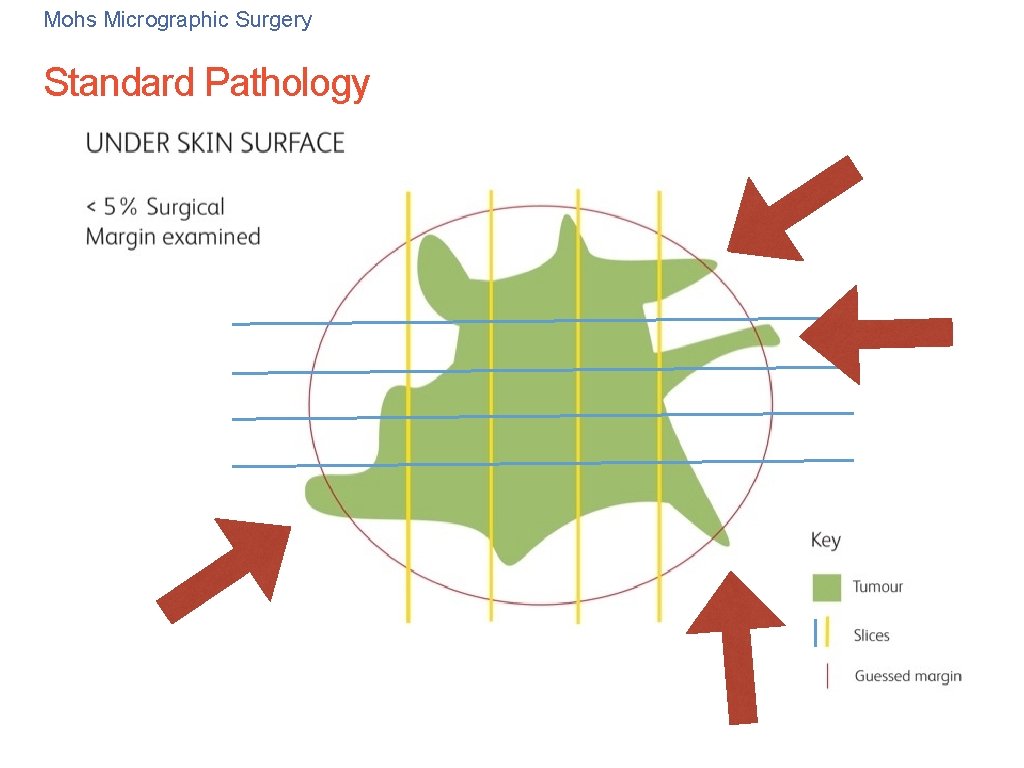 Mohs Micrographic Surgery Standard Pathology Mohs Micrographic Surgery Standard Pathology