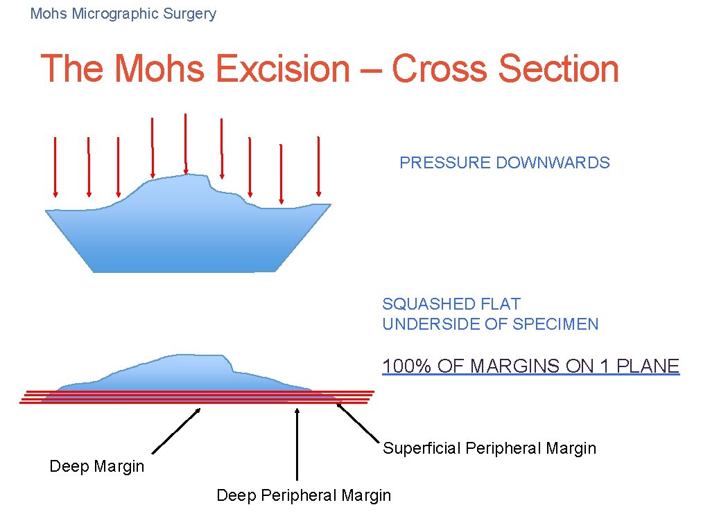 32 Mohs Micrographic Surgery The Mohs Excision – Cross Section PRESSURE DOWNWARDS SQUASHED FLAT 32 Mohs Micrographic Surgery The Mohs Excision – Cross Section PRESSURE DOWNWARDS SQUASHED FLAT