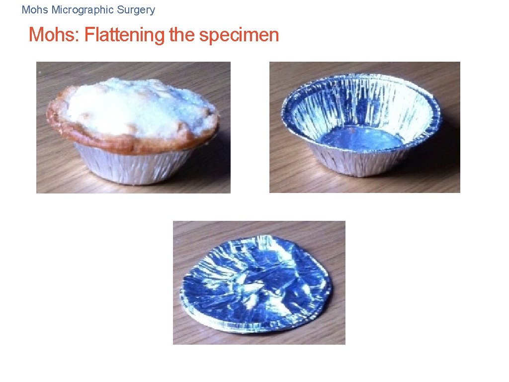 Mohs Micrographic Surgery Mohs: Flattening the specimen 33 Mohs Micrographic Surgery Mohs: Flattening the specimen 33