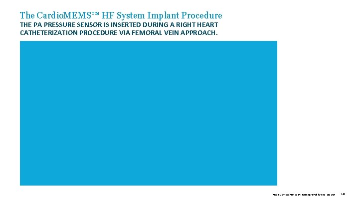 The Cardio. MEMS™ HF System Implant Procedure THE PA PRESSURE SENSOR IS INSERTED DURING