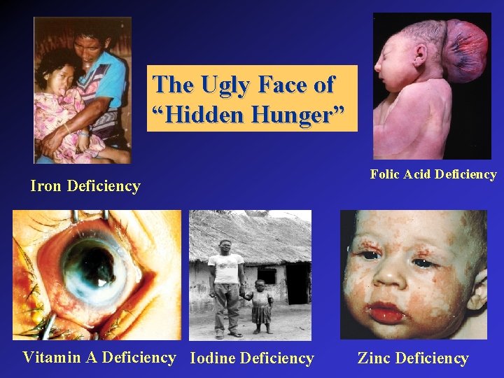 The Ugly Face of “Hidden Hunger” Iron Deficiency Vitamin A Deficiency Iodine Deficiency Folic