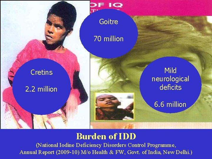 Goitre 70 million Mild neurological deficits Cretins 2. 2 million 6. 6 million Burden