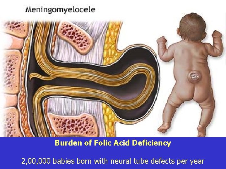 Burden of Folic Acid Deficiency 2, 000 babies born with neural tube defects per