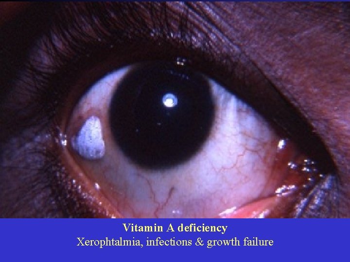 Vitamin A deficiency Xerophtalmia, infections & growth failure 