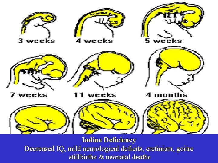 Iodine Deficiency Decreased IQ, mild neurological deficits, cretinism, goitre stillbirths & neonatal deaths 