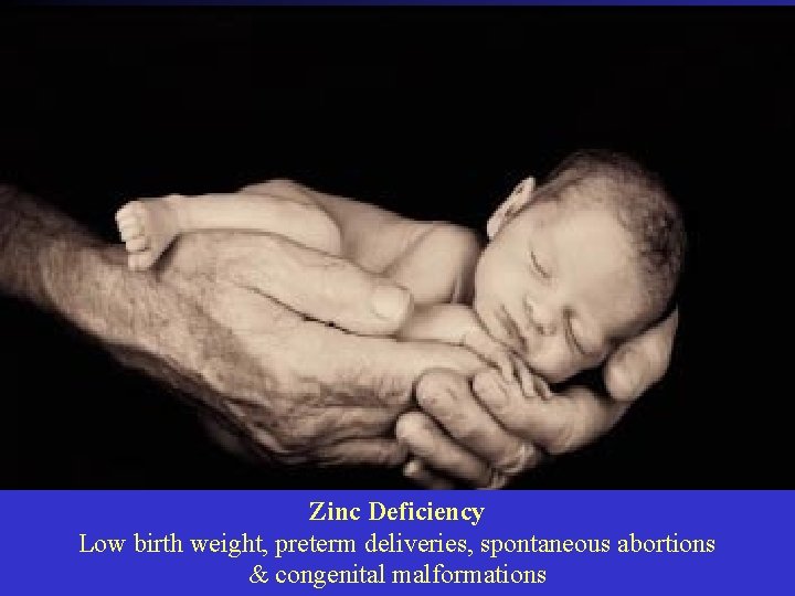 Zinc Deficiency Low birth weight, preterm deliveries, spontaneous abortions & congenital malformations 