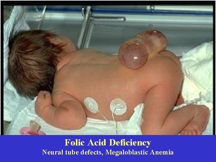 Folic Acid Deficiency Neural tube defects, Megaloblastic Anemia 