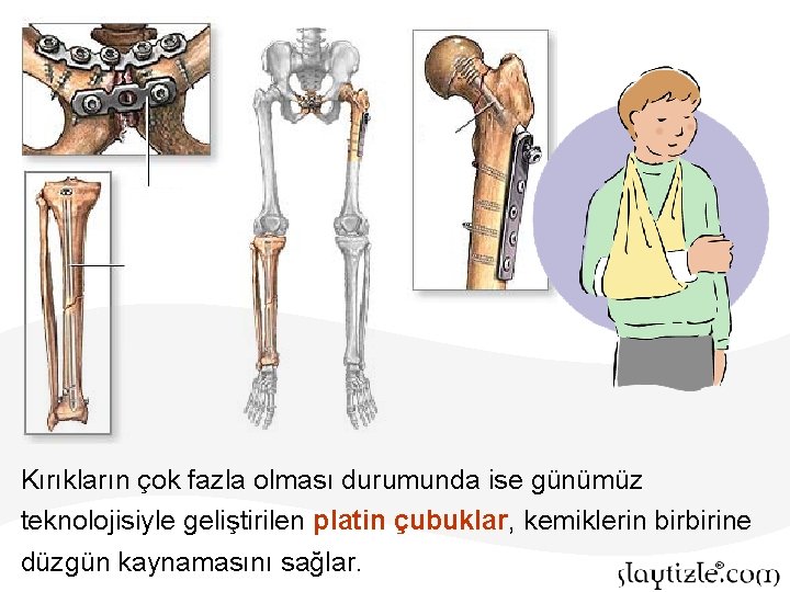 Kırıkların çok fazla olması durumunda ise günümüz teknolojisiyle geliştirilen platin çubuklar, kemiklerin birbirine düzgün