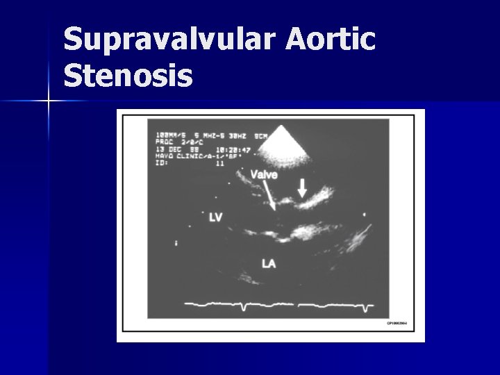 Supravalvular Aortic Stenosis 