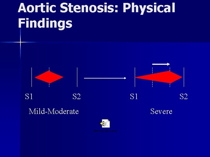 Aortic Stenosis: Physical Findings S 1 S 2 Mild-Moderate S 1 S 2 Severe