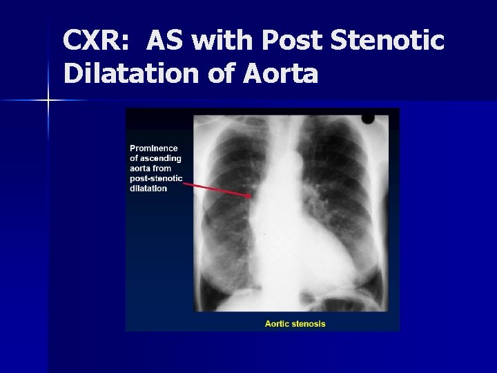 CXR: AS with Post Stenotic Dilatation of Aorta 