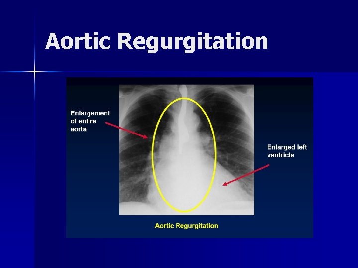 Aortic Regurgitation 