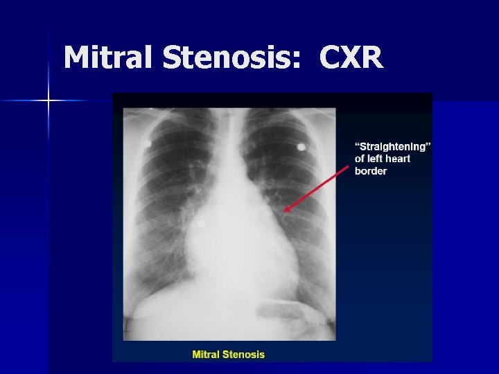 Mitral Stenosis: CXR Mitral Stenosis: CXR