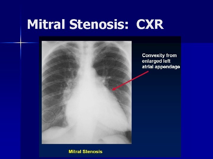 Mitral Stenosis: CXR 