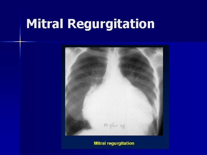 Mitral Regurgitation 