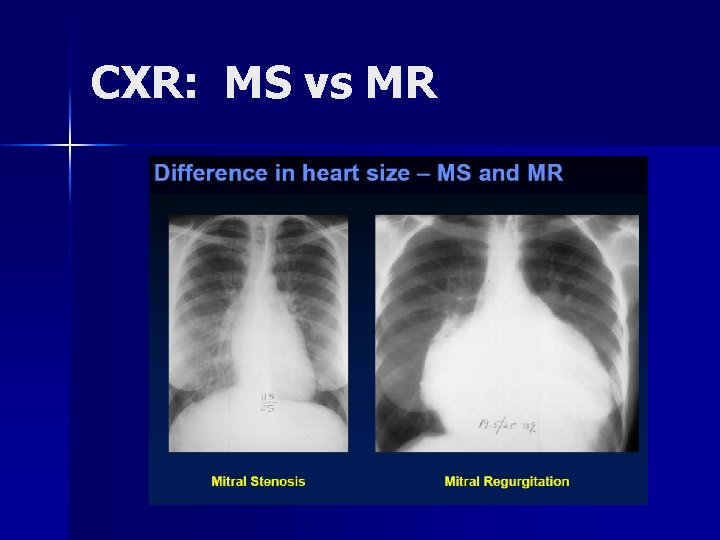 CXR: MS vs MR 