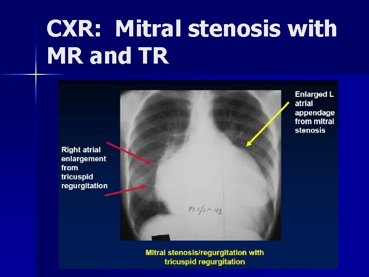 CXR: Mitral stenosis with MR and TR 