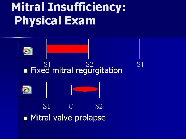 Mitral Insufficiency: Physical Exam n S 1 Fixed mitral regurgitation S 1 n S