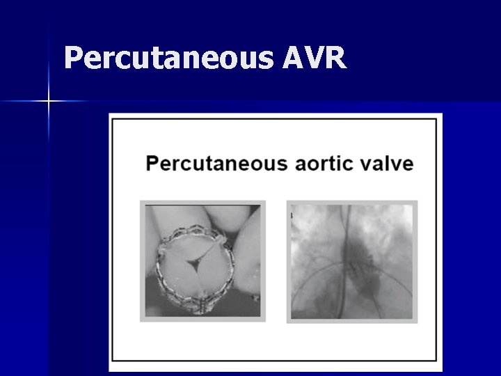 Percutaneous AVR 