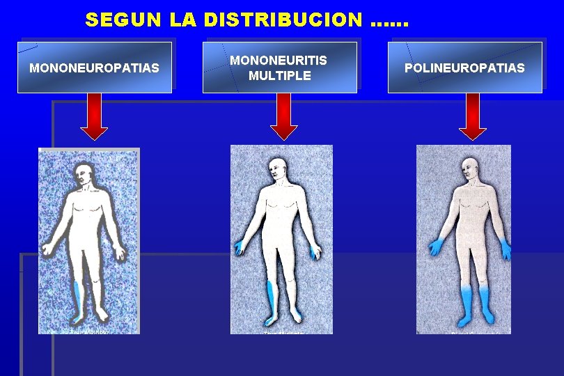 SEGUN LA DISTRIBUCION …… MONONEUROPATIAS MONONEURITIS MULTIPLE POLINEUROPATIAS 