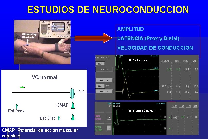 ESTUDIOS DE NEUROCONDUCCION AMPLITUD LATENCIA (Prox y Distal) VELOCIDAD DE CONDUCCION N. Cubital motor