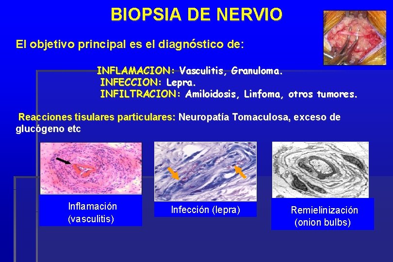 BIOPSIA DE NERVIO El objetivo principal es el diagnóstico de: INFLAMACION: Vasculitis, Granuloma. INFECCION: