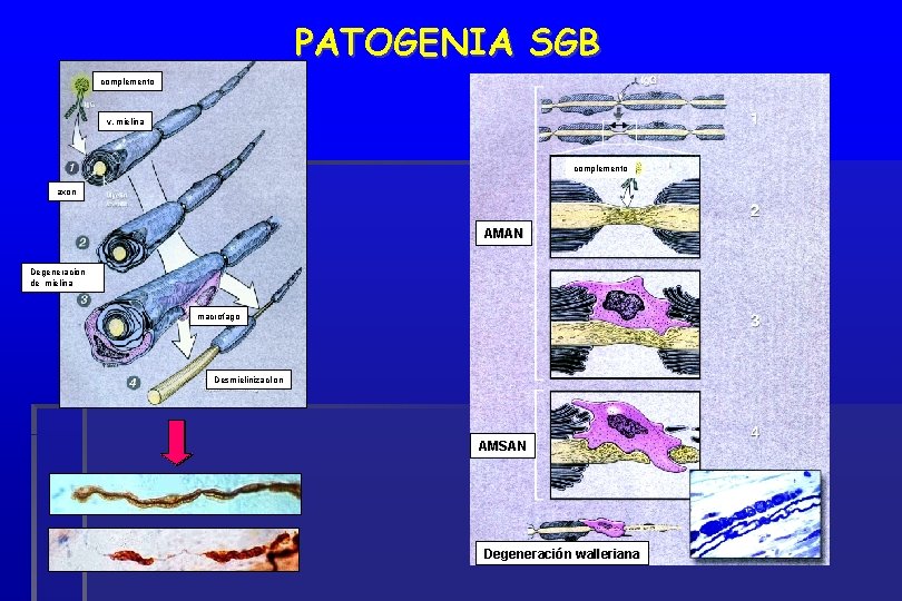 PATOGENIA SGB complemento v. mielina complemento axon AMAN Degeneracion de mielina macrofago Desmielinizaci’on AMSAN