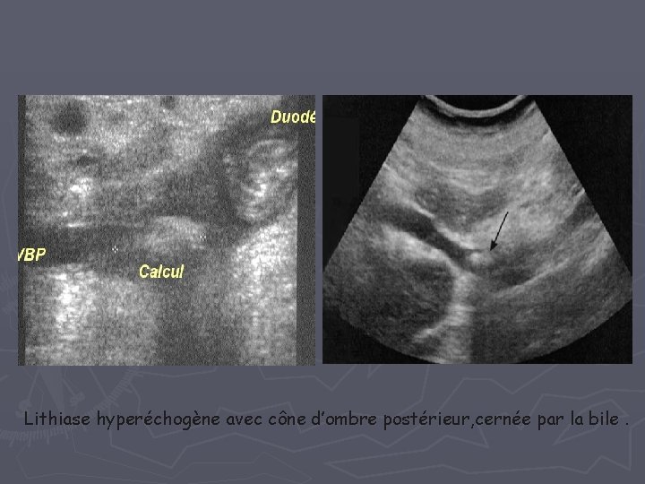 Lithiase hyperéchogène avec cône d’ombre postérieur, cernée par la bile. Lithiase hyperéchogène avec cône d’ombre postérieur, cernée par la bile.