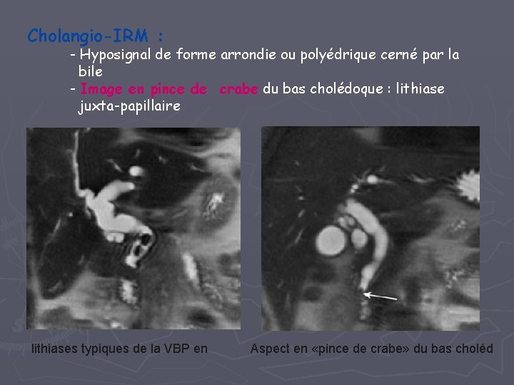 Cholangio-IRM : - Hyposignal de forme arrondie ou polyédrique cerné par la bile -