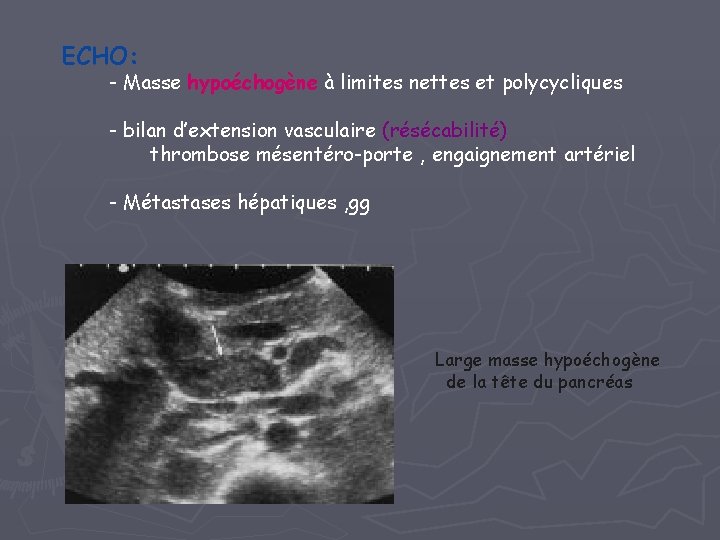 ECHO: - Masse hypoéchogène à limites nettes et polycycliques - bilan d’extension vasculaire (résécabilité)
