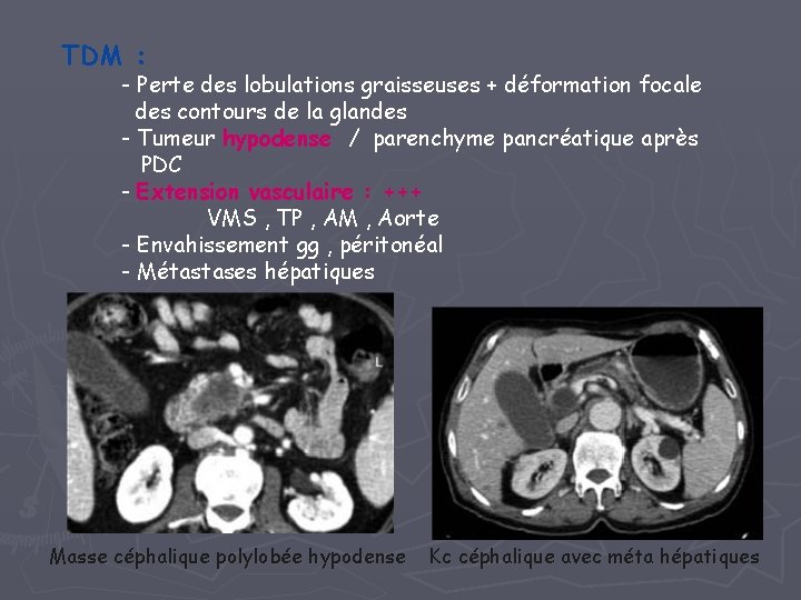 TDM : - Perte des lobulations graisseuses + déformation focale des contours de la TDM : - Perte des lobulations graisseuses + déformation focale des contours de la