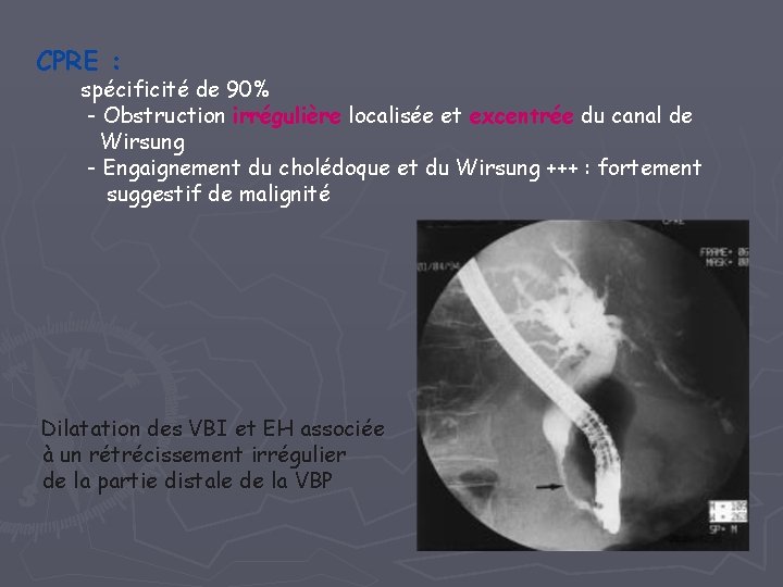 CPRE : spécificité de 90% - Obstruction irrégulière localisée et excentrée du canal de