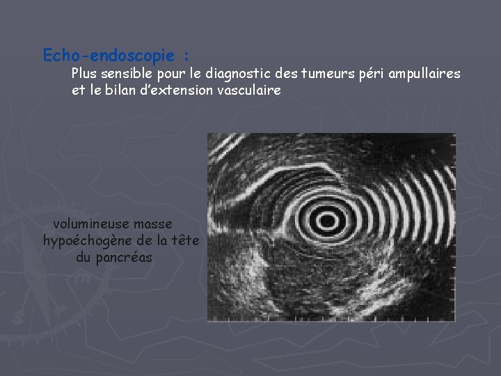 Echo-endoscopie : Plus sensible pour le diagnostic des tumeurs péri ampullaires et le bilan Echo-endoscopie : Plus sensible pour le diagnostic des tumeurs péri ampullaires et le bilan