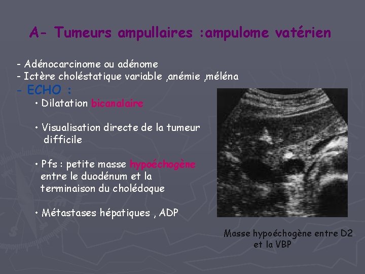 A- Tumeurs ampullaires : ampulome vatérien - Adénocarcinome ou adénome - Ictère choléstatique variable