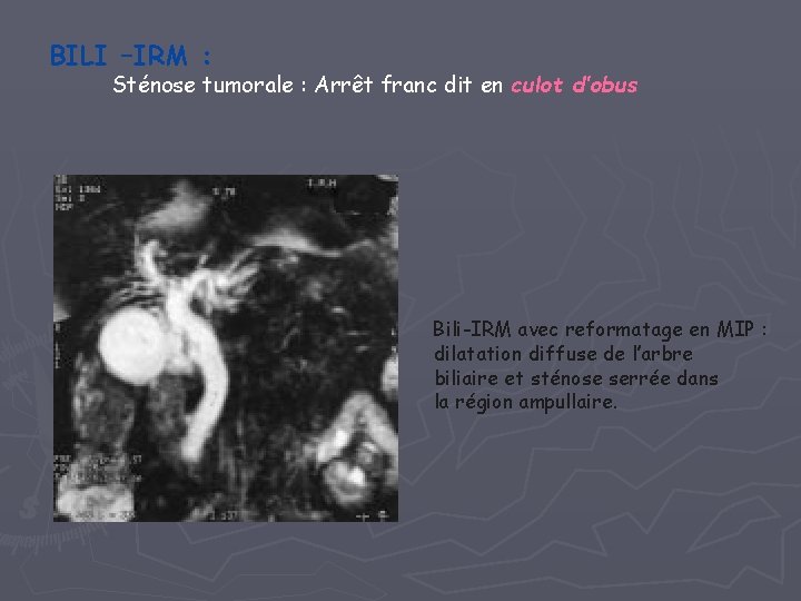 BILI –IRM : Sténose tumorale : Arrêt franc dit en culot d’obus Bili-IRM avec