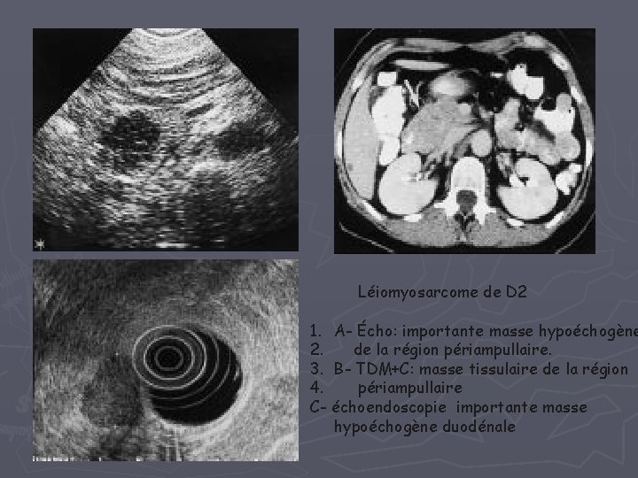 Léiomyosarcome de D 2 1. A- Écho: importante masse hypoéchogène 2. de la région