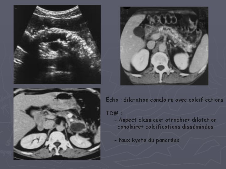 Écho : dilatation canalaire avec calcifications TDM : - Aspect classique: atrophie+ dilatation canalaire+